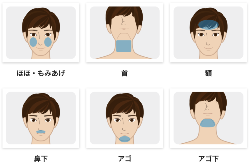 メンズジェニー　顔脱毛　画像